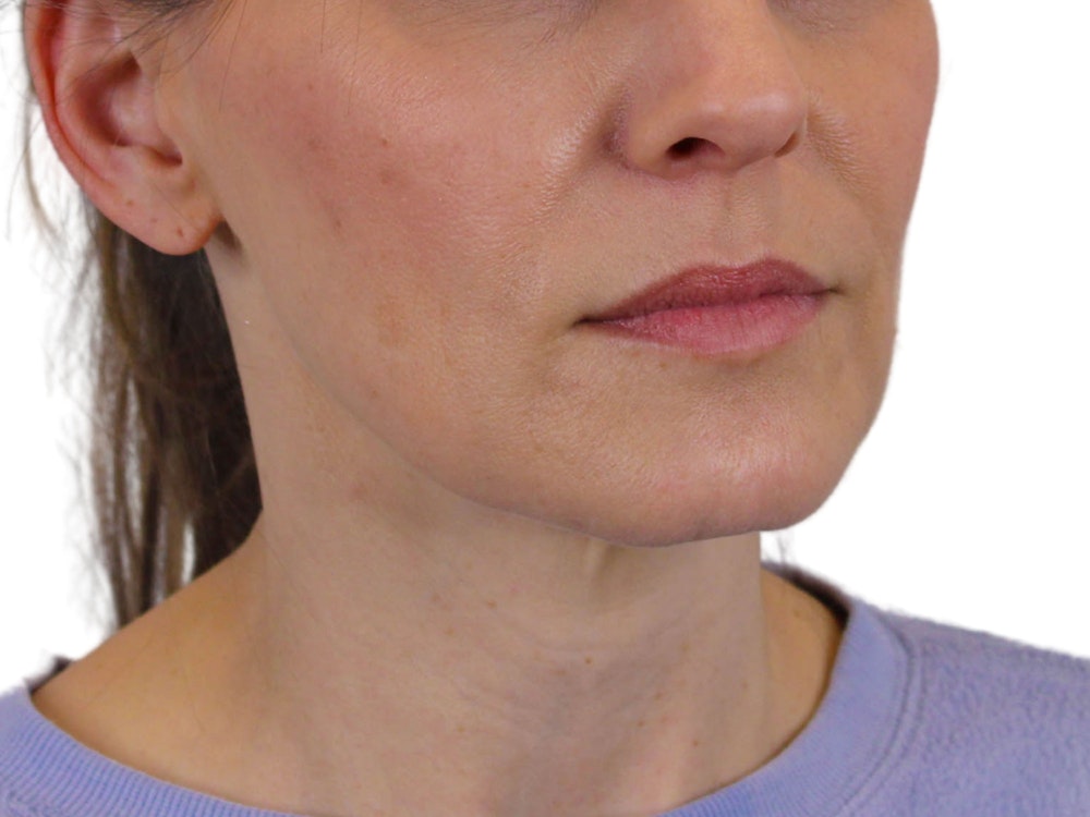 Deep Neck Lift Before & After Gallery - Patient 122751194 - Image 3