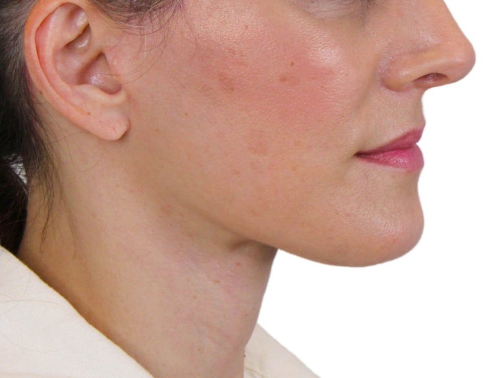 Deep Neck Lift Before & After Gallery - Patient 122751194 - Image 4