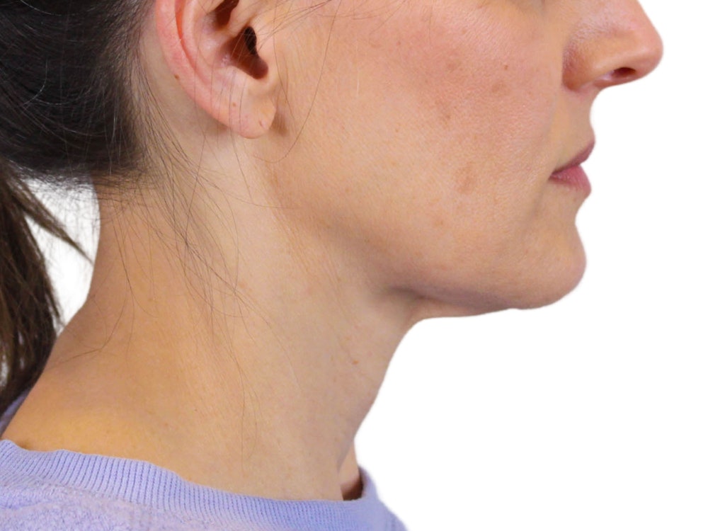 Deep Neck Lift Before & After Gallery - Patient 122751194 - Image 5