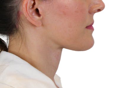 Deep Neck Lift Before & After Gallery - Patient 122751194 - Image 6
