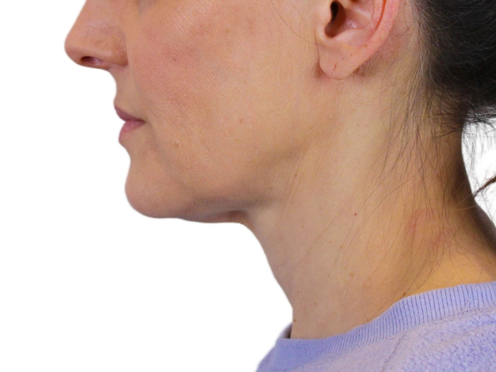 Deep Neck Lift Before & After Gallery - Patient 122751194 - Image 9