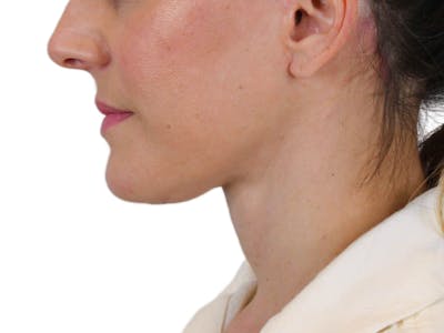 Deep Neck Lift Before & After Gallery - Patient 122751194 - Image 10