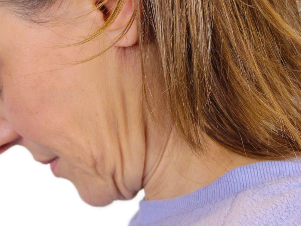 Deep Neck Lift Before & After Gallery - Patient 122751194 - Image 13