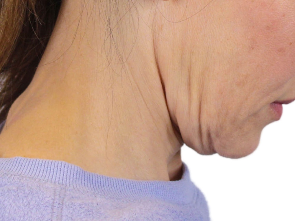 Deep Neck Lift Before & After Gallery - Patient 122751194 - Image 7