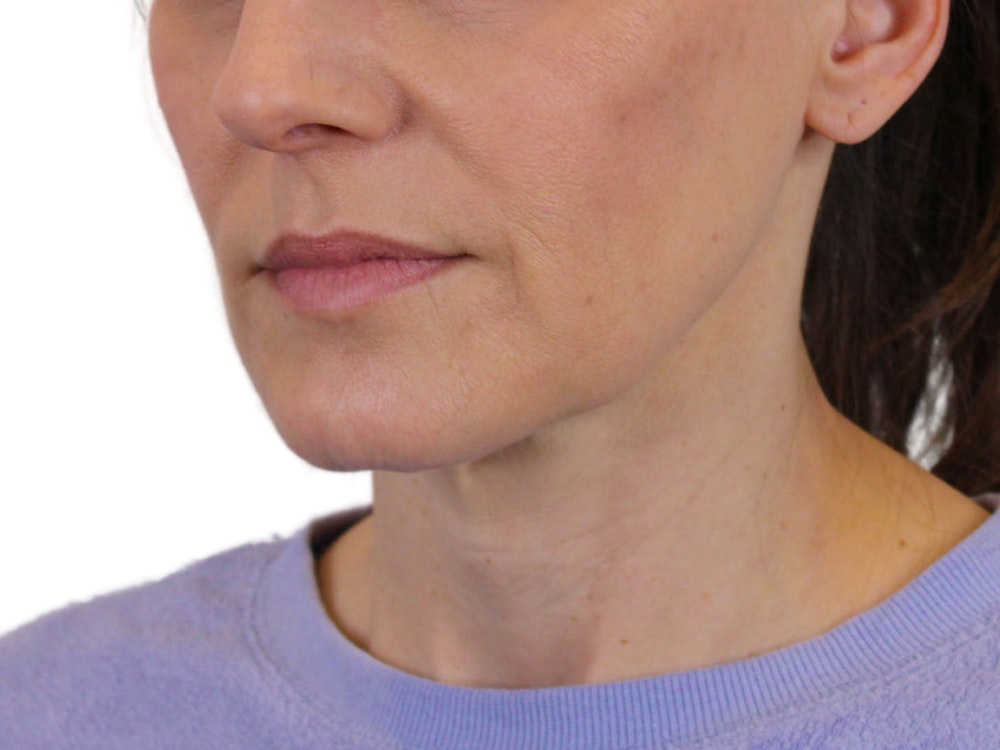 Deep Neck Lift Before & After Gallery - Patient 122751194 - Image 11