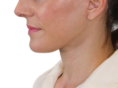 Deep Neck Lift Before & After Gallery - Patient 122751194 - Image 12