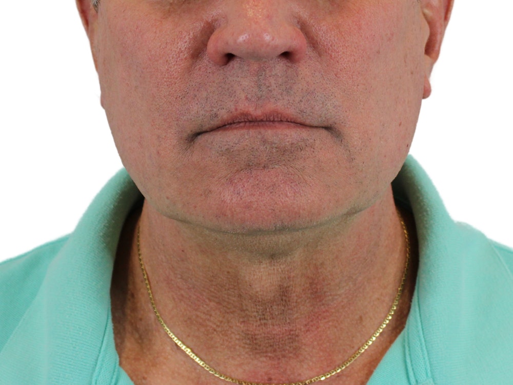Deep Neck Lift Before & After Gallery - Patient 131840908 - Image 1