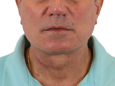 Deep Neck Lift Before & After Gallery - Patient 131840908 - Image 2