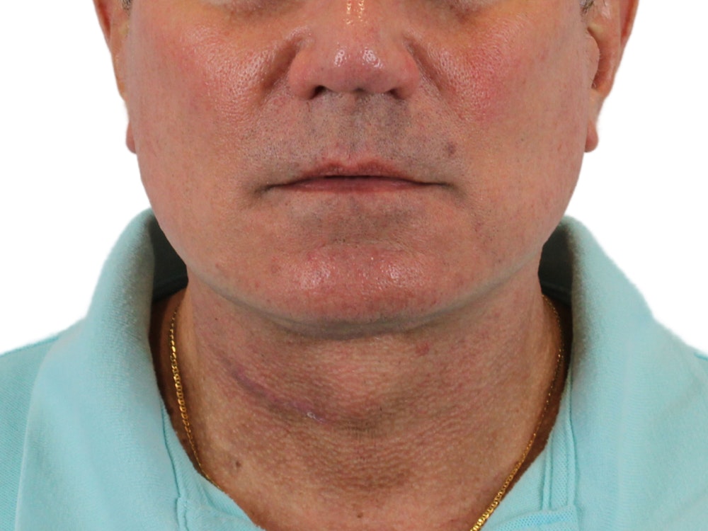 Deep Neck Lift Before & After Gallery - Patient 131840908 - Image 2