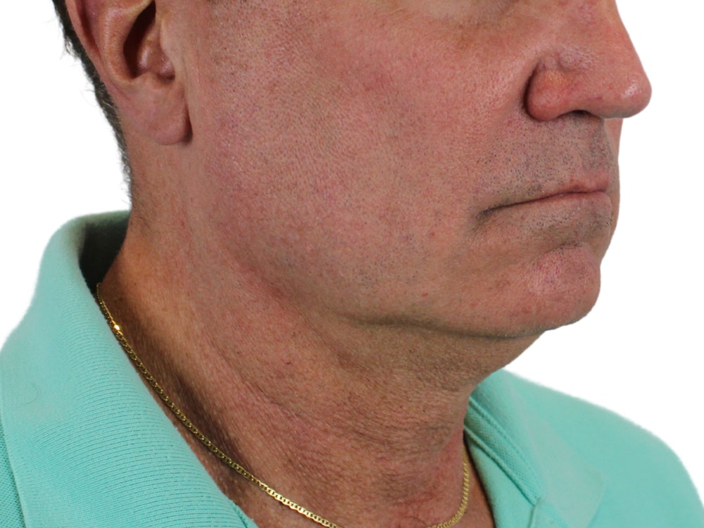 Deep Neck Lift Before & After Gallery - Patient 131840908 - Image 3