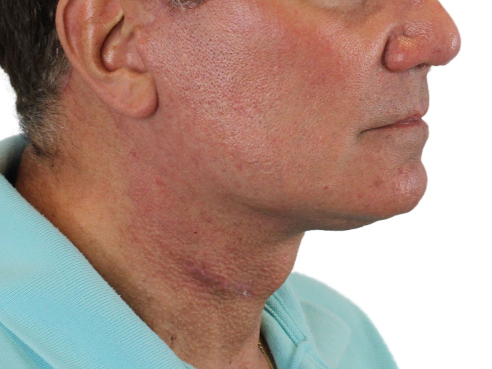 Deep Neck Lift Before & After Gallery - Patient 131840908 - Image 4