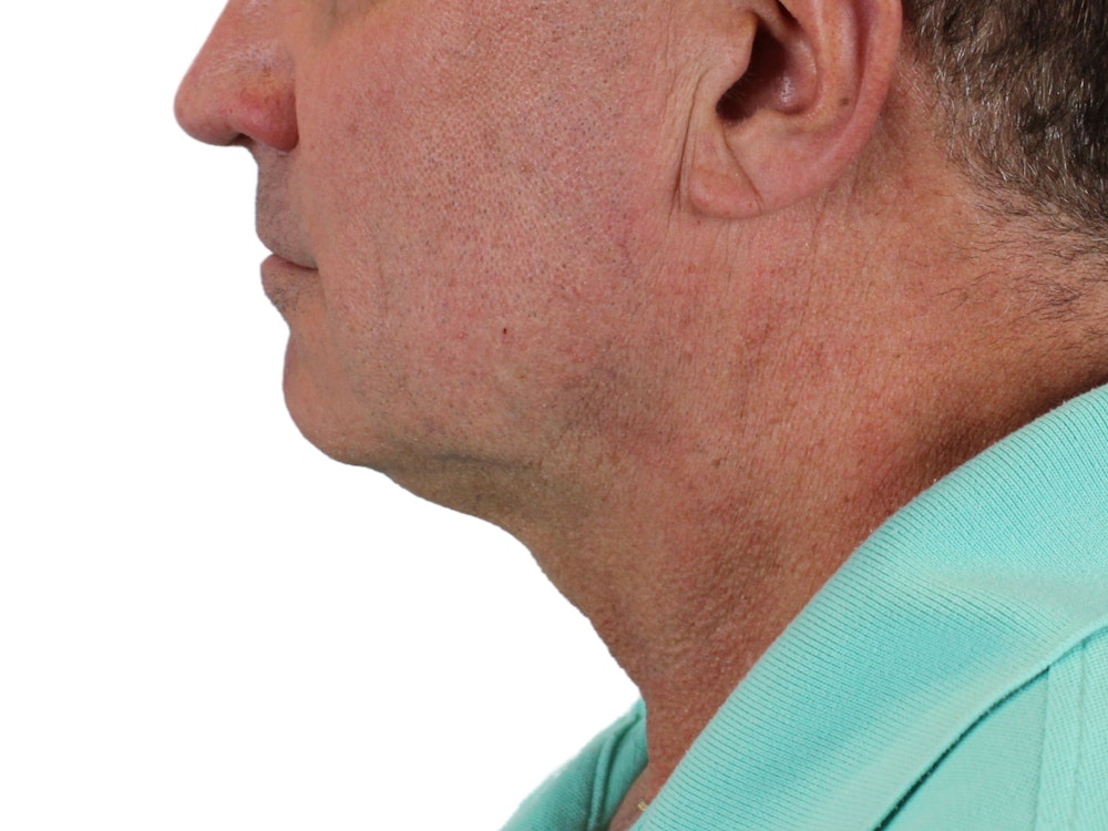 Deep Neck Lift Before & After Gallery - Patient 131840908 - Image 7