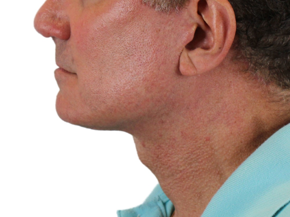 Deep Neck Lift Before & After Gallery - Patient 131840908 - Image 8
