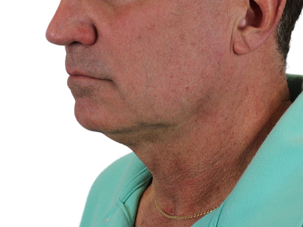 Deep Neck Lift Before & After Gallery - Patient 131840908 - Image 9