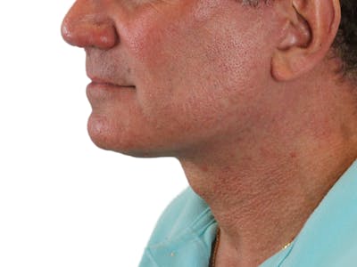 Deep Neck Lift Before & After Gallery - Patient 131840908 - Image 10