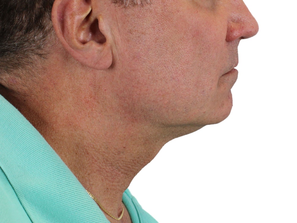 Deep Neck Lift Before & After Gallery - Patient 131840908 - Image 5