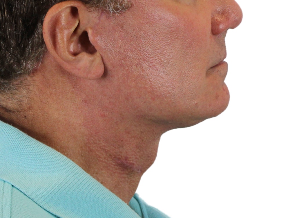 Deep Neck Lift Before & After Gallery - Patient 131840908 - Image 6