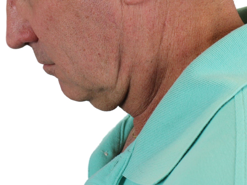 Deep Neck Lift Before & After Gallery - Patient 131840908 - Image 11