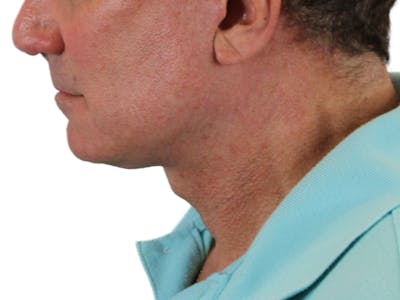 Deep Neck Lift Before & After Gallery - Patient 131840908 - Image 12