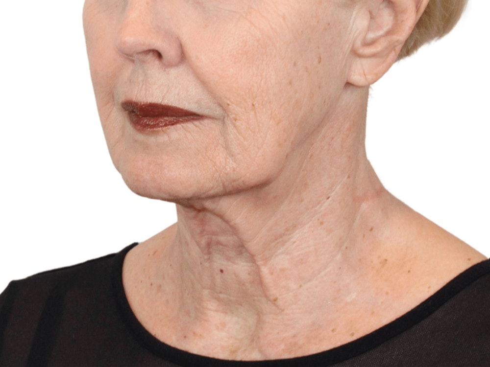 Deep Neck Lift Before & After Gallery - Patient 157358271 - Image 3