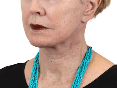 Deep Neck Lift Before & After Gallery - Patient 157358271 - Image 4