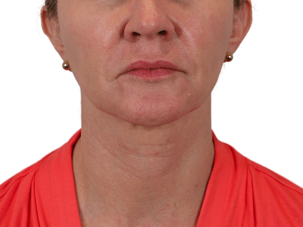 Deep Neck Lift Before & After Gallery - Patient 143804965 - Image 1