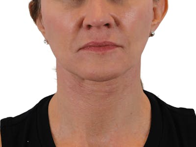 Deep Neck Lift Before & After Gallery - Patient 143804965 - Image 2