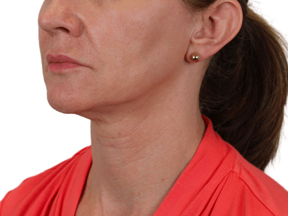 Deep Neck Lift Before & After Gallery - Patient 143804965 - Image 3