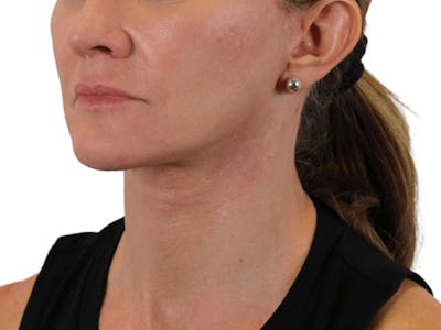 Deep Neck Lift Before & After Gallery - Patient 143804965 - Image 4