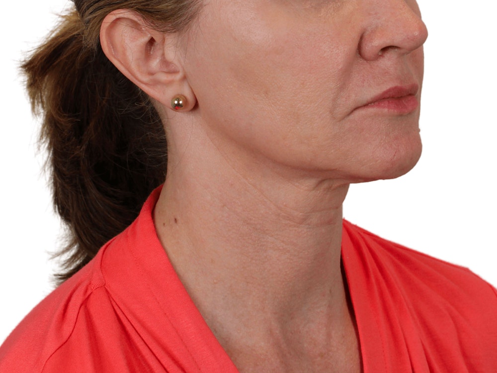 Deep Neck Lift Before & After Gallery - Patient 143804965 - Image 5
