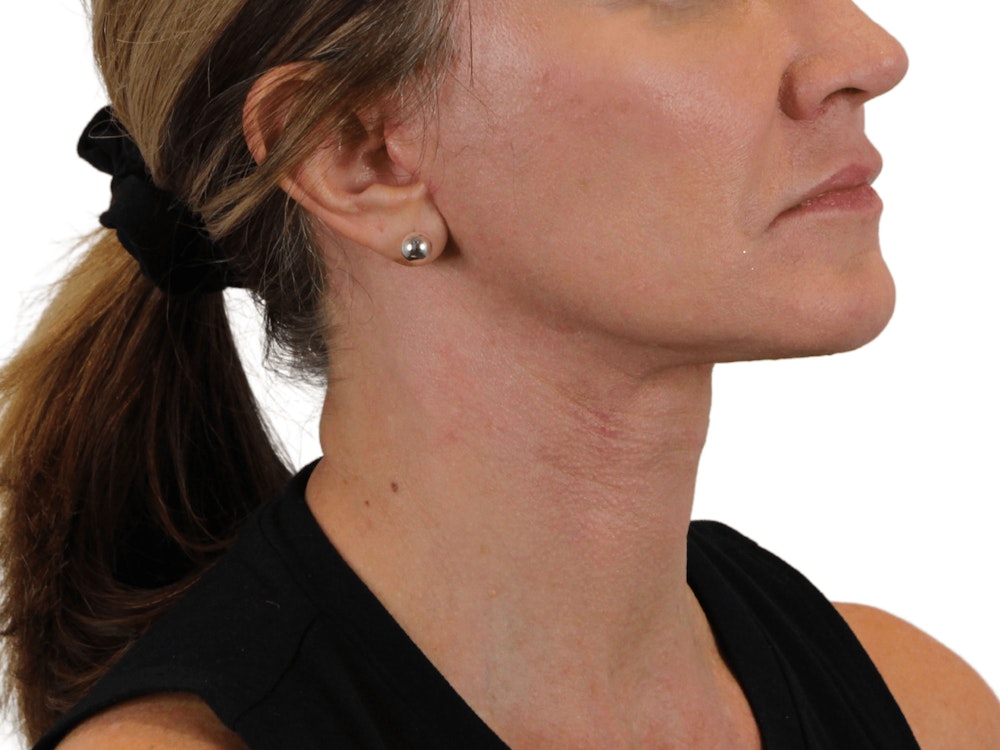 Deep Neck Lift Before & After Gallery - Patient 143804965 - Image 6
