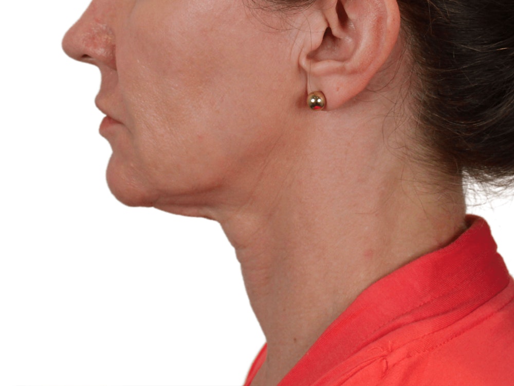Deep Neck Lift Before & After Gallery - Patient 143804965 - Image 7
