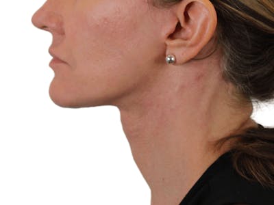 Deep Neck Lift Before & After Gallery - Patient 143804965 - Image 8