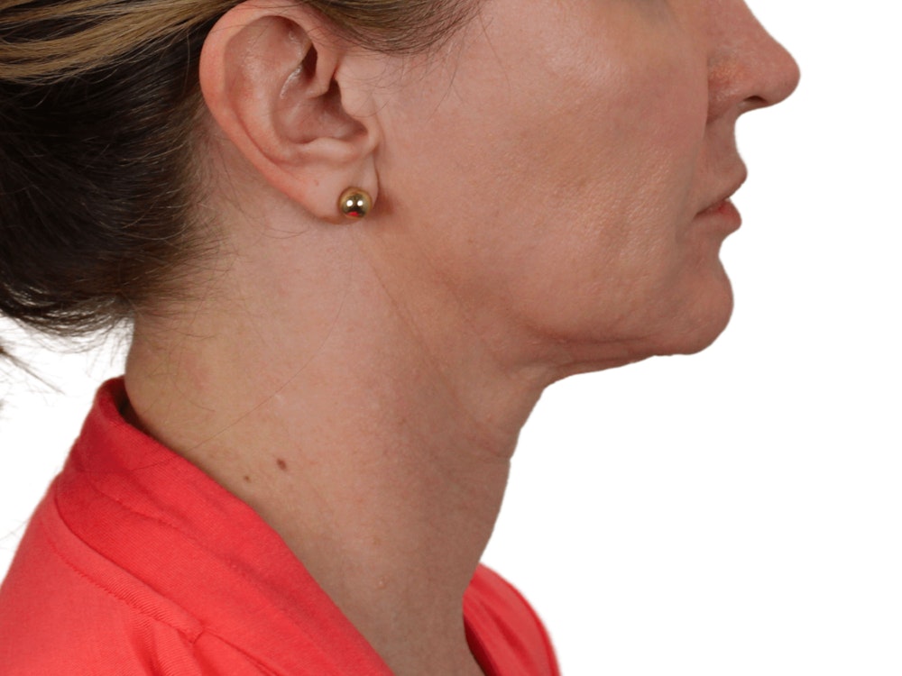 Deep Neck Lift Before & After Gallery - Patient 143804965 - Image 9