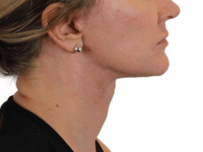Deep Neck Lift Before & After Gallery - Patient 143804965 - Image 10