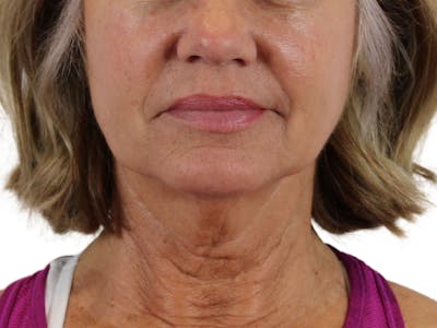 Deep Neck Lift Before & After Gallery - Patient 146130641 - Image 1