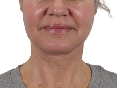 Deep Neck Lift Before & After Gallery - Patient 146130641 - Image 2