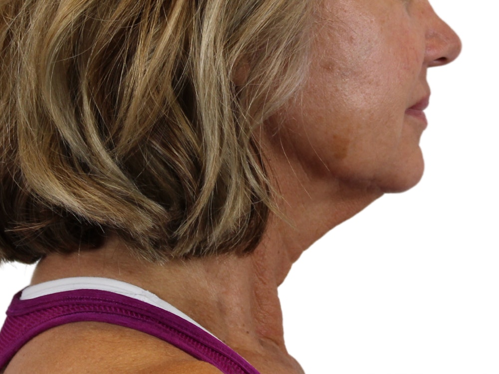 Deep Neck Lift Before & After Gallery - Patient 146130641 - Image 3