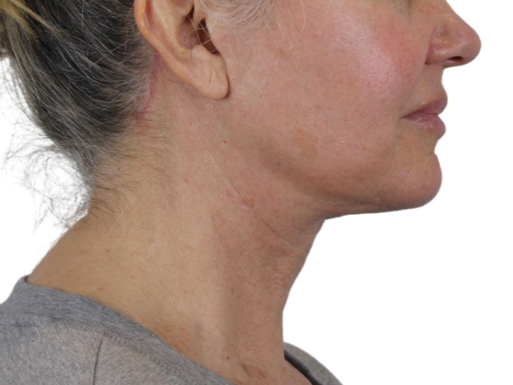 Deep Neck Lift Before & After Gallery - Patient 146130641 - Image 4