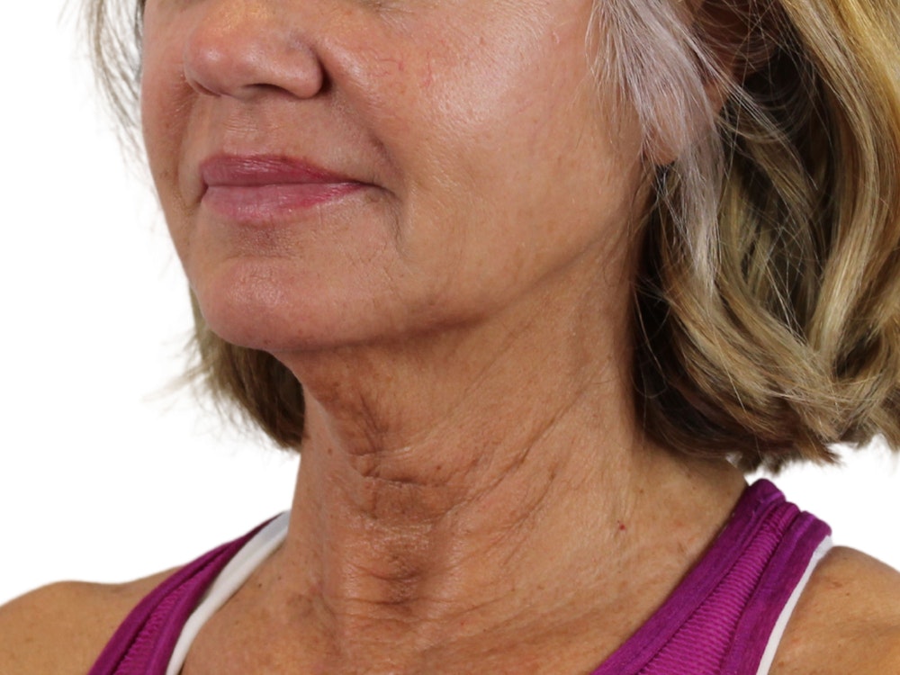 Deep Neck Lift Before & After Gallery - Patient 146130641 - Image 5