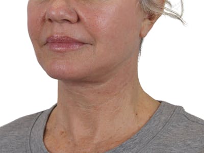 Deep Neck Lift Before & After Gallery - Patient 146130641 - Image 6