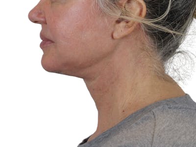 Deep Neck Lift Before & After Gallery - Patient 146130641 - Image 8