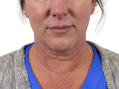 Deep Neck Lift Before & After Gallery - Patient 147538134 - Image 1