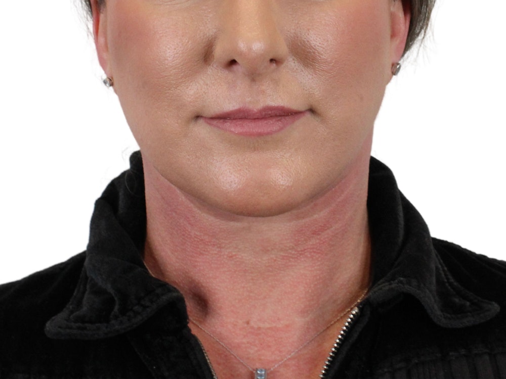 Deep Neck Lift Before & After Gallery - Patient 147538134 - Image 2