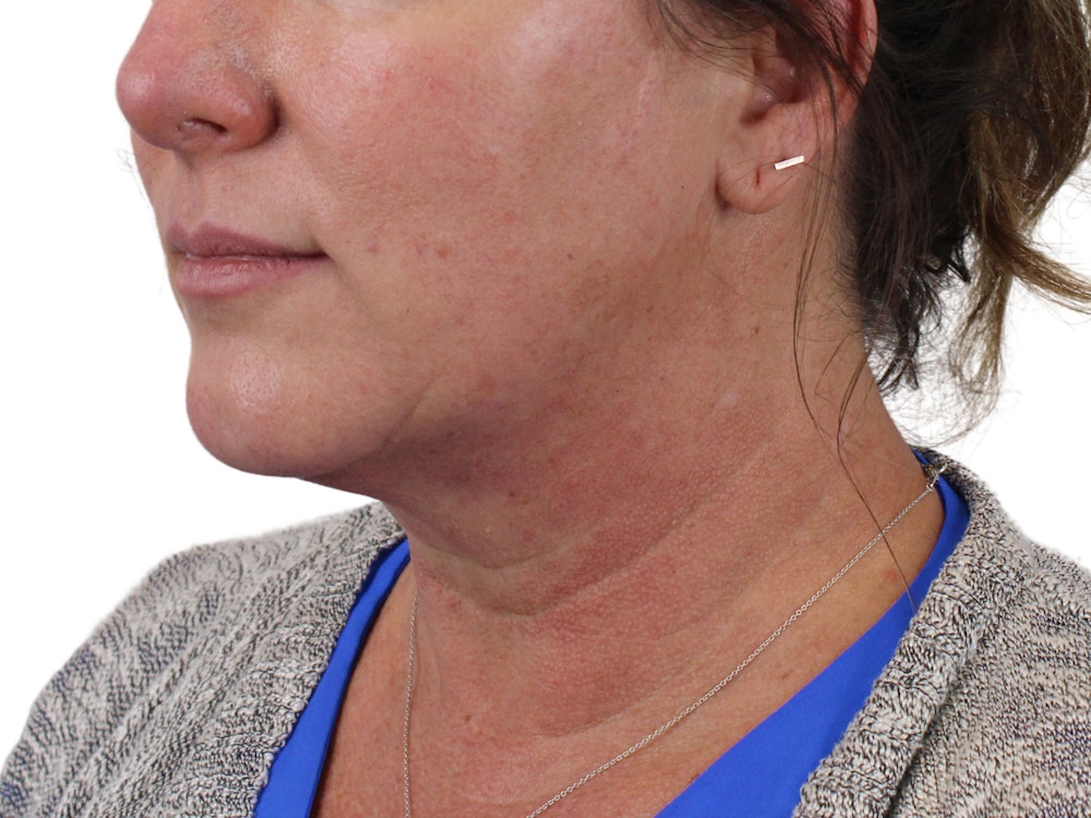 Deep Neck Lift Before & After Gallery - Patient 147538134 - Image 3