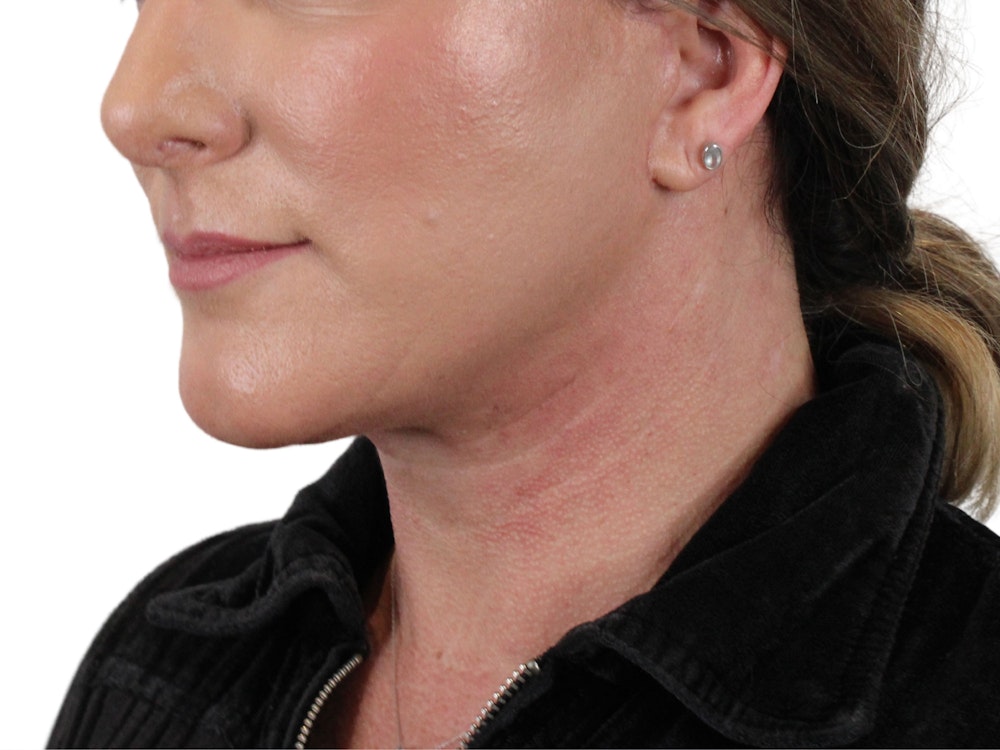Deep Neck Lift Before & After Gallery - Patient 147538134 - Image 4