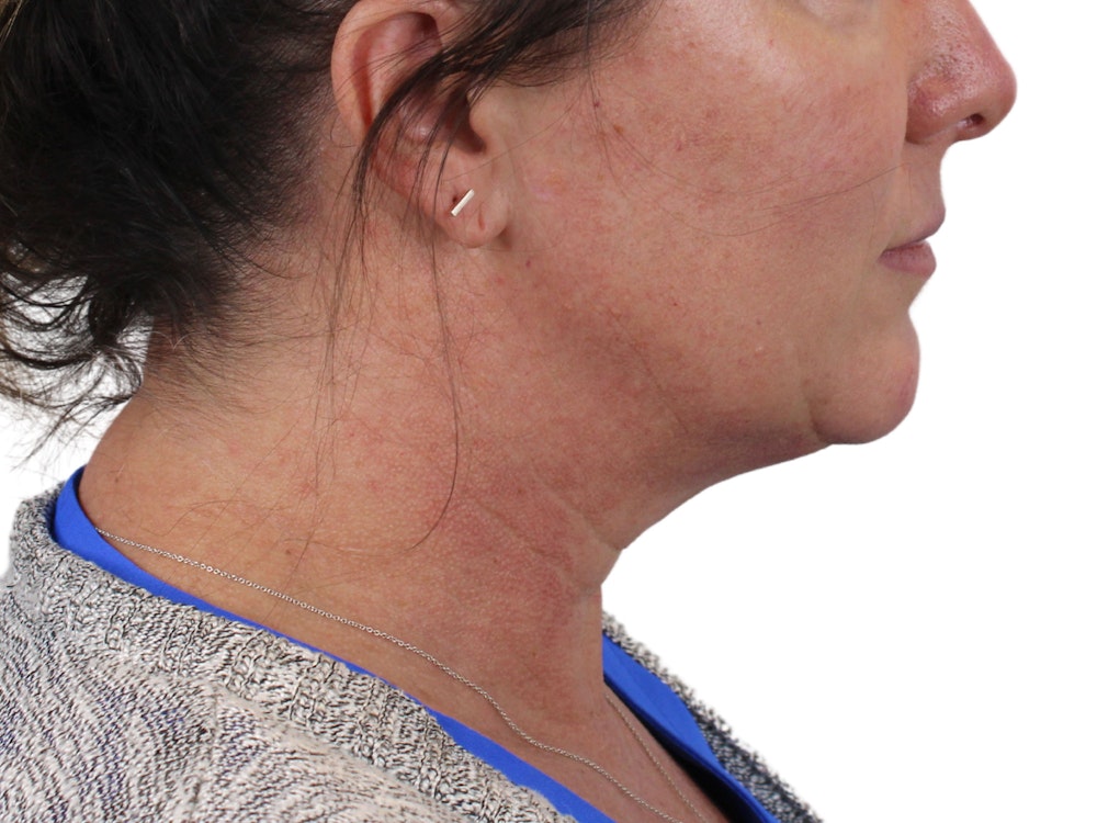 Deep Neck Lift Before & After Gallery - Patient 147538134 - Image 5