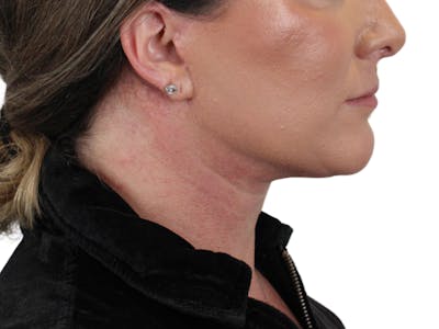 Deep Neck Lift Before & After Gallery - Patient 147538134 - Image 6