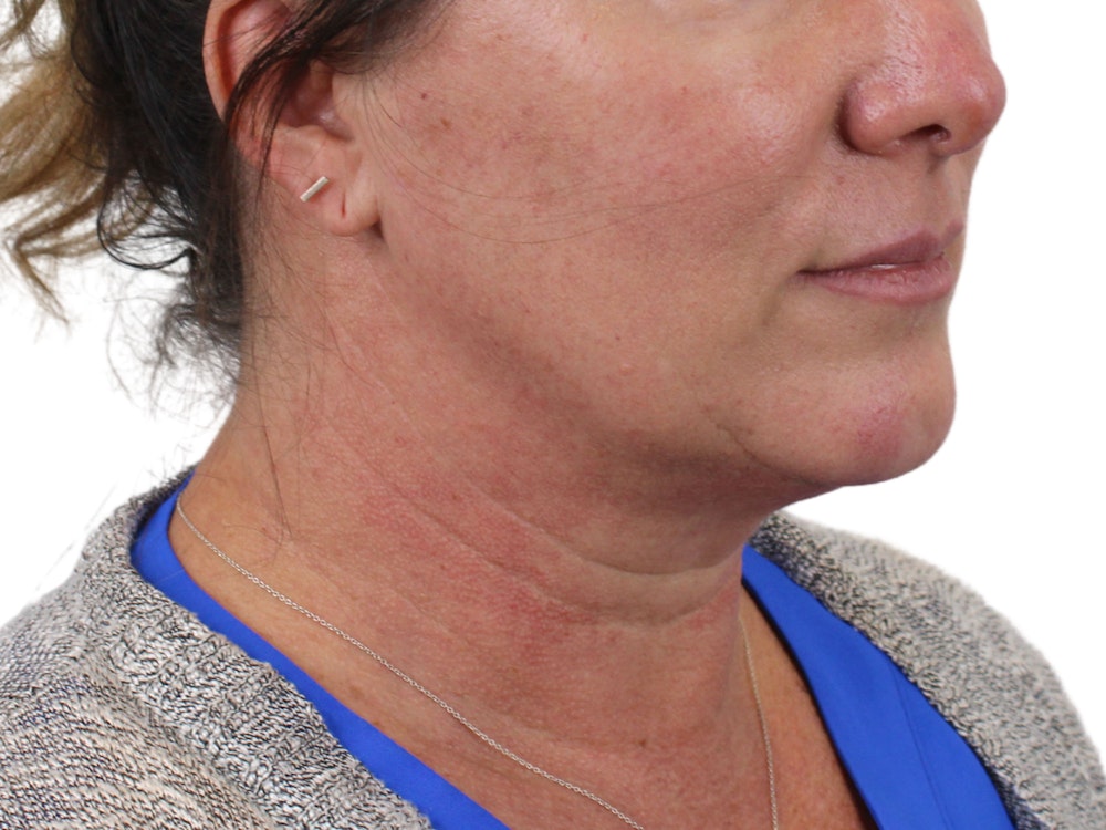 Deep Neck Lift Before & After Gallery - Patient 147538134 - Image 7