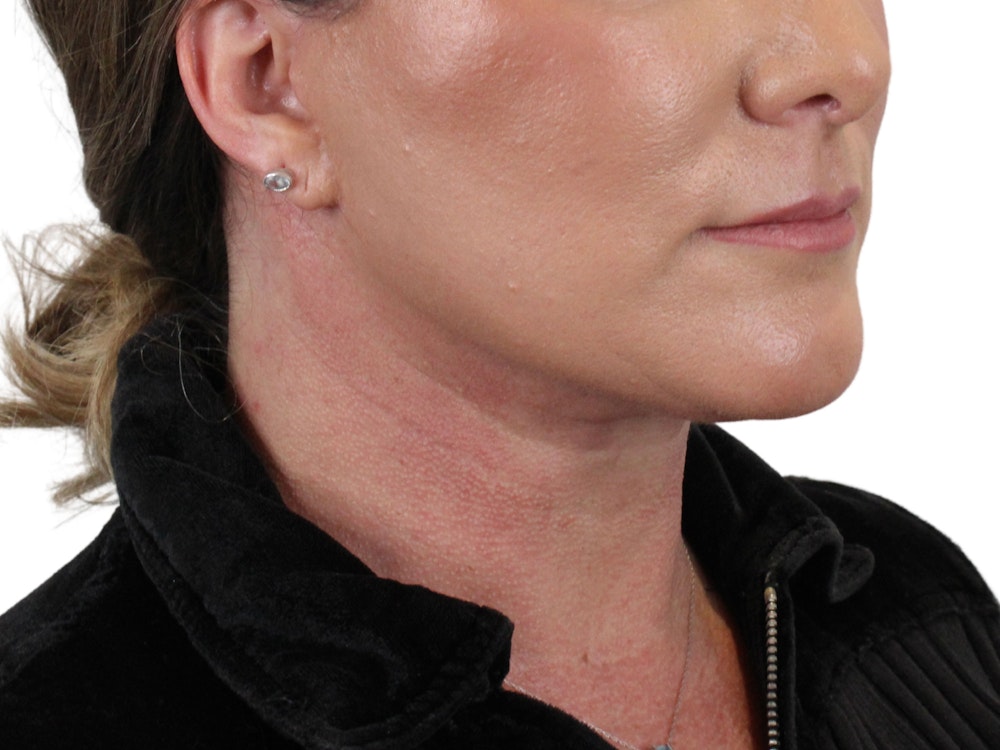 Deep Neck Lift Before & After Gallery - Patient 147538134 - Image 8